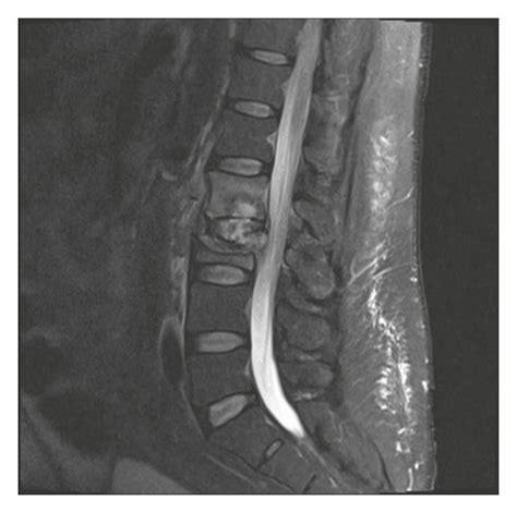 compression test fracture|compression fracture mri without contrast.